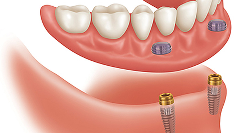 Denture over implants