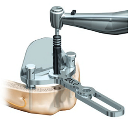 Trefoil implant cost